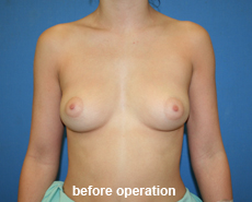 plastic-surgery-breast-augmentation